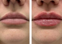How much do Lip Fillers Cost?